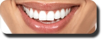 veneers